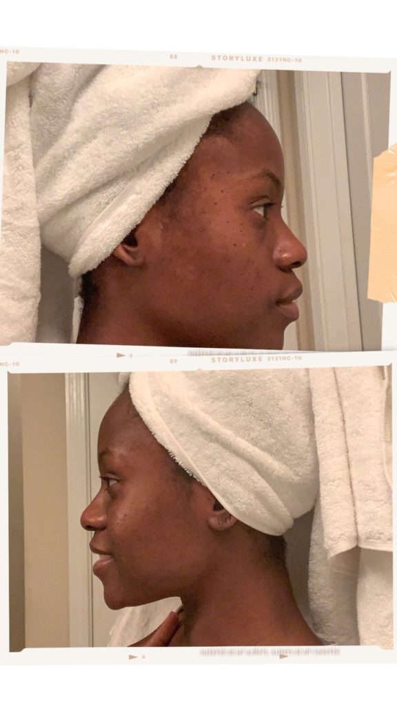 Mario badescu, Pixi by Petra, eradikate, Peter Thomas Roth, drunk elephant, vitamin c, superfood sunscreen, clear skin, skincare regimen, pregnancy acne, hyperpigmentation, 